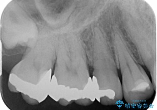 奥歯がしみて痛いの治療前