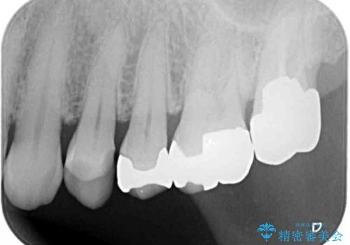 外れてしまった銀歯 セラミックインレーで自然な仕上がりにの治療前