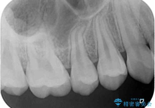 歯と歯の間の虫歯 セラミックインレーでの治療の治療後
