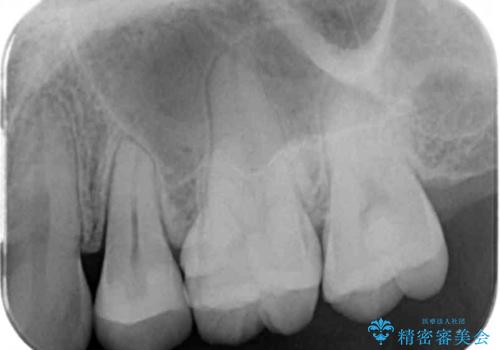 銀の詰め物を白くしたい セラミックインレーでの治療の治療後