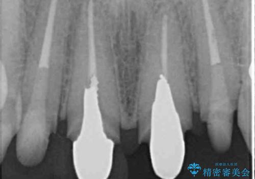 前歯をきれいにしたいの治療中