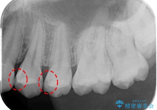歯と歯の間の虫歯 セラミックインレーでの治療の治療前