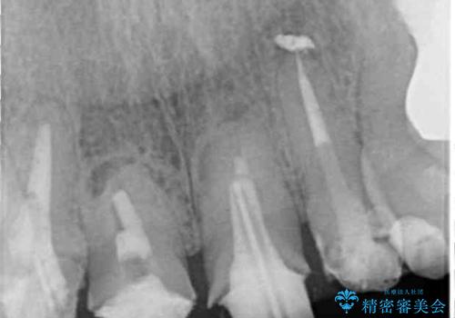 仮歯のまま放置した前歯 オールセラミッククラウンで自然な前歯にの治療前