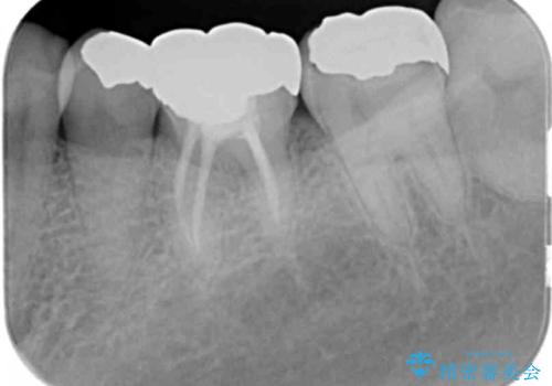 目立つ銀歯を白くしたいの治療前
