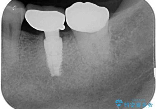 しみる奥歯 オールセラミッククラウンによる補綴治療の治療後