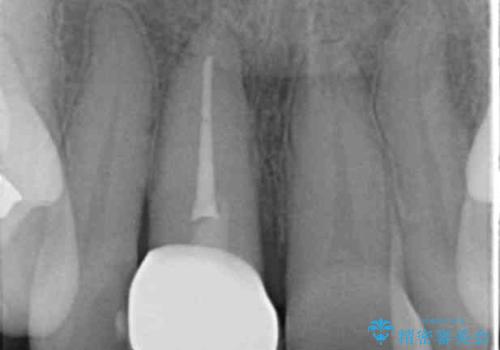転んで前歯を折った　歯を抜かない治療の治療後