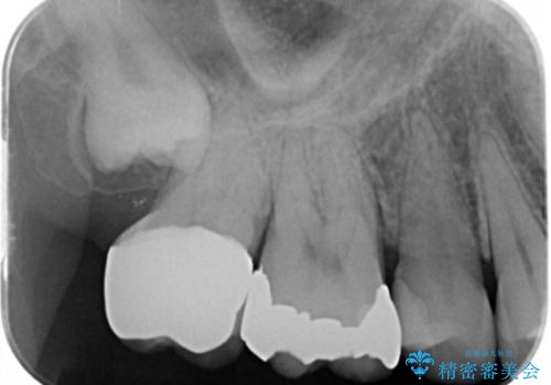 奥歯がしみて痛いの治療後