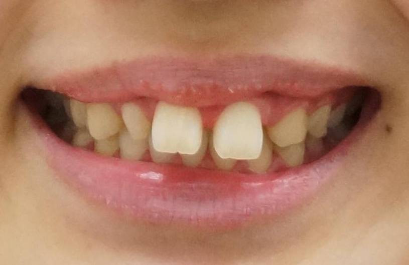 前歯が出っ歯ですきっ歯　抜かずに前歯を見た目良くの治療前（顔貌）
