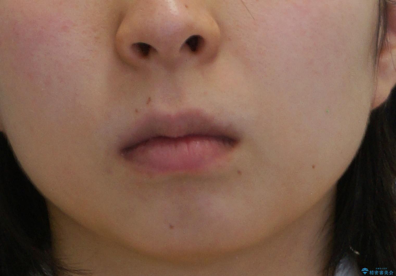 八重歯 歯並びのがたつきの治療後(顔貌)