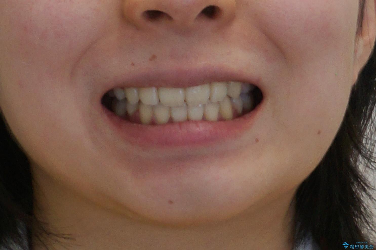 八重歯　歯並びのがたつきの治療後（顔貌）