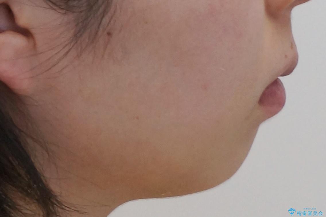 八重歯 歯並びのがたつきの治療後(顔貌)