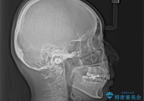 上顎前歯の突出を軽減 インビザラインによる抜歯矯正の治療後