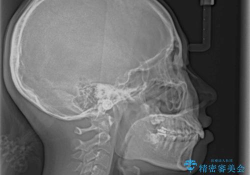 下顎前歯が隠れて突出した口元 ワイヤー装置での抜歯矯正の治療前