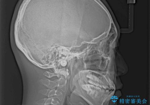 口元の突出感を改善 受け口傾向の咬み合わせの抜歯矯正の治療前