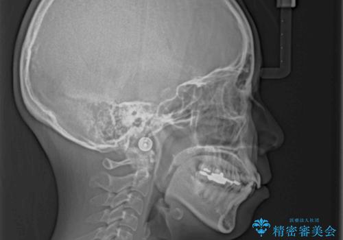 デコボコと口元の突出感 ハーフリンガルでの抜歯矯正の治療前
