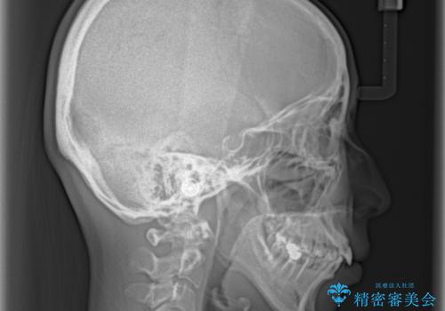 出っ歯と咬み合わせを改善 ワイヤー装置の抜歯矯正の治療前
