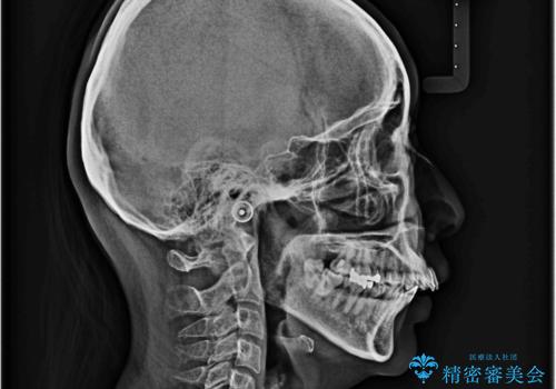 上顎前歯の突出を軽減 インビザラインによる抜歯矯正の治療前