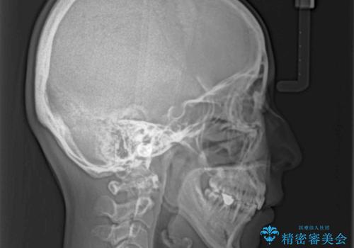 出っ歯と咬み合わせを改善 ワイヤー装置の抜歯矯正の治療後