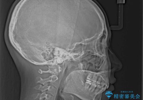 下顎前歯が隠れて突出した口元 ワイヤー装置での抜歯矯正の治療後