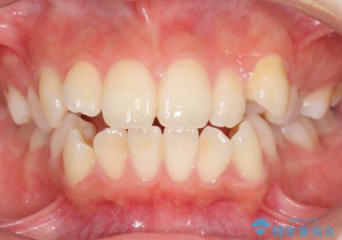 八重歯　歯並びのがたつきの症例 治療前