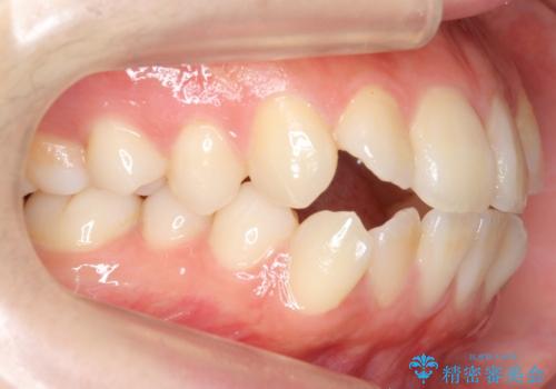 八重歯 歯並びのがたつきの治療前