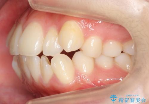 八重歯 歯並びのがたつきの治療前