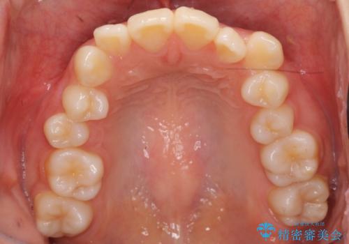 八重歯 歯並びのがたつきの治療前