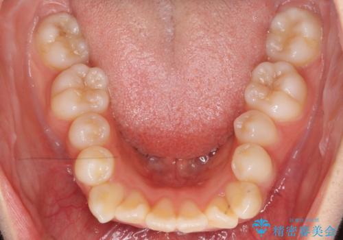 八重歯　歯並びのがたつきの治療前