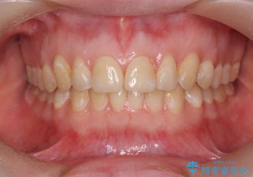 マウスピース矯正で行う出っ歯の治療の症例 治療後