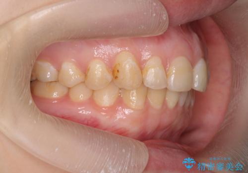 マウスピース矯正で行う出っ歯の治療の治療後