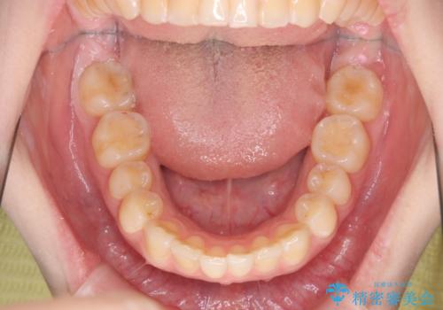 マウスピース矯正で行う出っ歯の治療の治療後