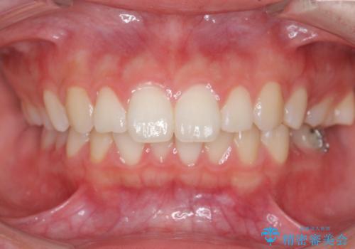 矯正治療を途中でやめてしまった、途中からの治療希望の症例 治療前