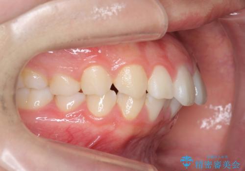 矯正治療を途中でやめてしまった、途中からの治療希望