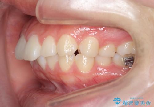 矯正治療を途中でやめてしまった、途中からの治療希望の治療前
