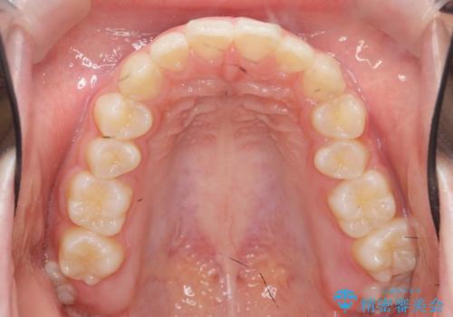 矯正治療を途中でやめてしまった、途中からの治療希望の治療前
