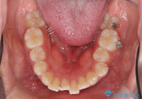 矯正治療を途中でやめてしまった、途中からの治療希望の治療前