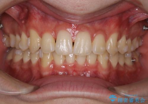 インビザライン:前歯のがたつきと噛み合わせの治療の治療中