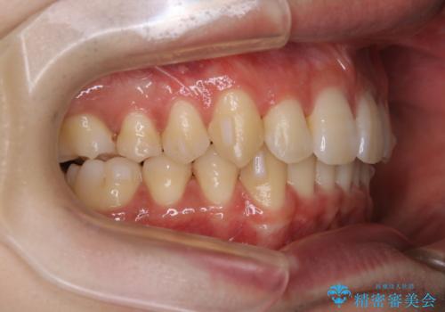 インビザライン:前歯のがたつきと噛み合わせの治療の治療中