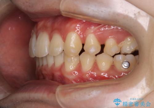 インビザライン:前歯のがたつきと噛み合わせの治療の治療中