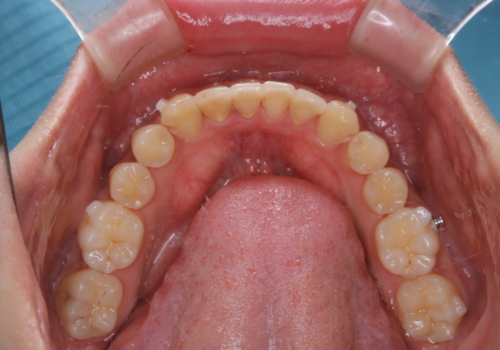 インビザライン:前歯のがたつきと噛み合わせの治療の治療中