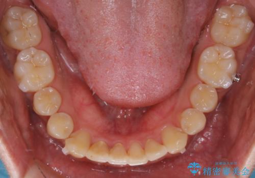 インビザライン:前歯のがたつきと噛み合わせの治療の治療中