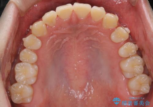 インビザライン:前歯のがたつきと噛み合わせの治療の治療中