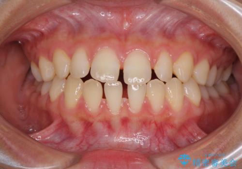 隙間だらけの歯列 インビザラインで改善の治療前