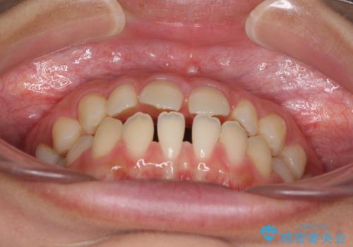 隙間だらけの歯列 インビザラインで改善の治療前