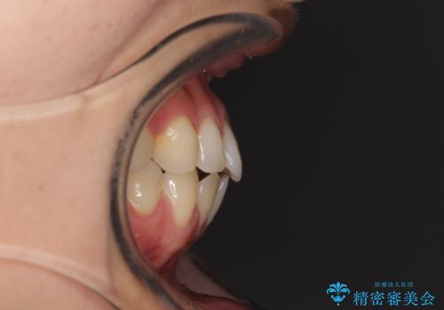 隙間だらけの歯列 インビザラインで改善の治療前