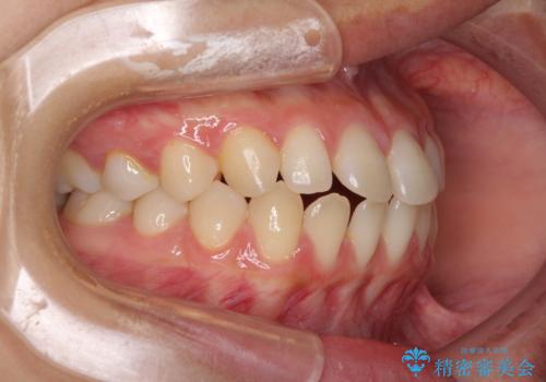 隙間だらけの歯列 インビザラインで改善の治療前