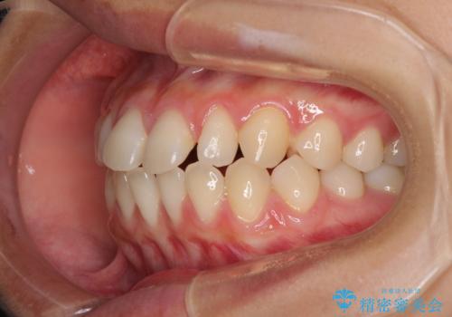 隙間だらけの歯列 インビザラインで改善の治療前