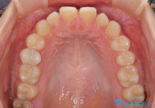 隙間だらけの歯列 インビザラインで改善の治療前