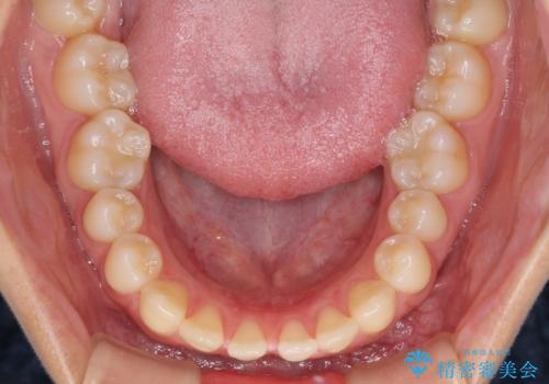 隙間だらけの歯列 インビザラインで改善の治療前