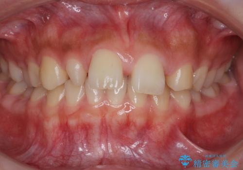 前歯が出っ歯ですきっ歯　抜かずに前歯を見た目良くの症例 治療前